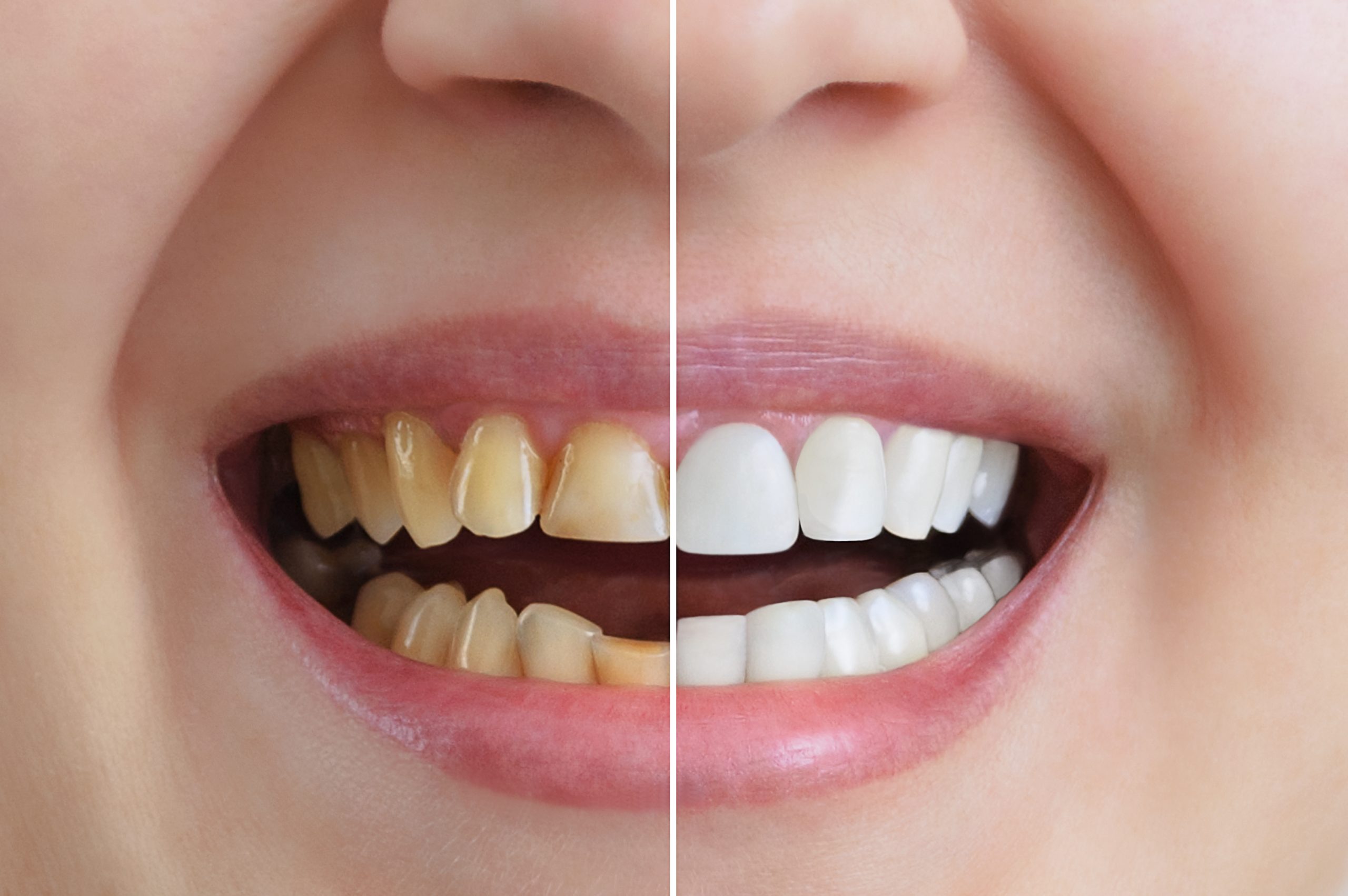 Все что нужно про отбеливание зубов – советы стоматолога NikaDent Family